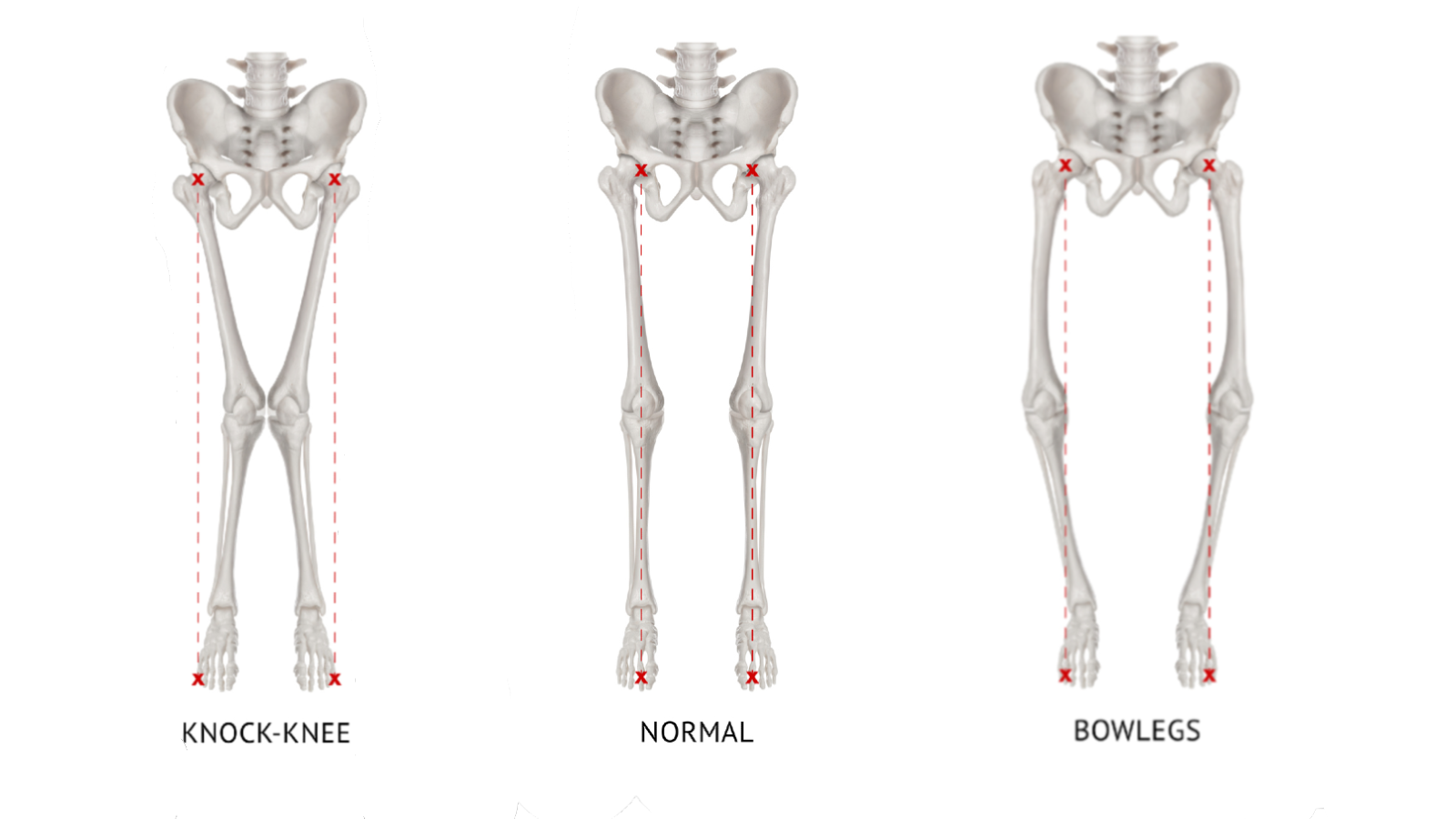 Diagram showing knock-knee, normal knee, and bow leg knee alignment